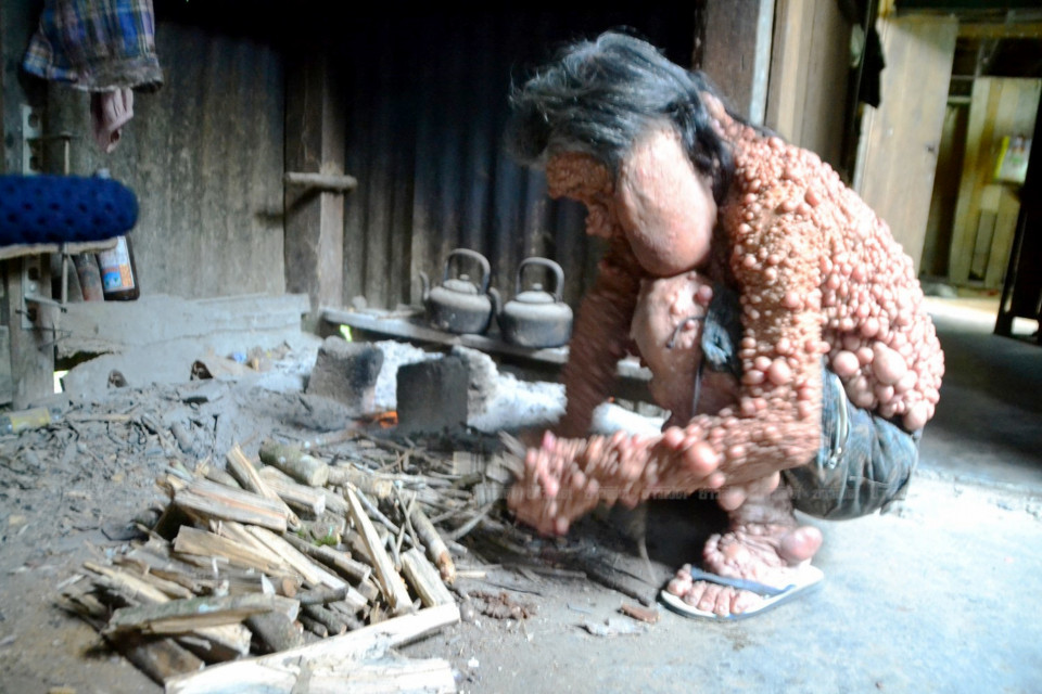Insolite : (Ames sensibles s'abstenir) : Atteint d'une tumeur bizarre, Shiti Charoenrattanaprapa, âgé de 60 ans, vit seul depuis 45 ans