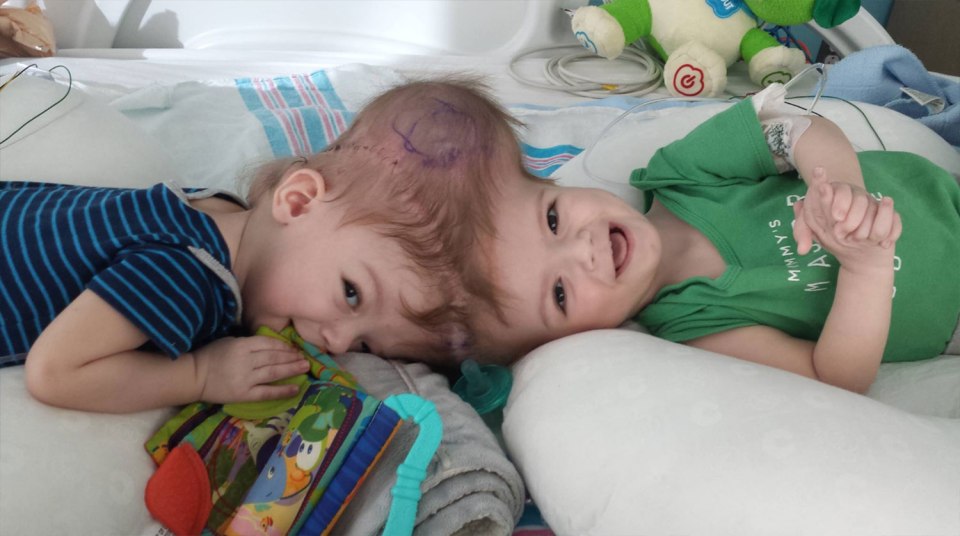 Anias et Jadon McDonald, âgés de 13 mois ont été séparés avec succès après 27 heures d'opération.