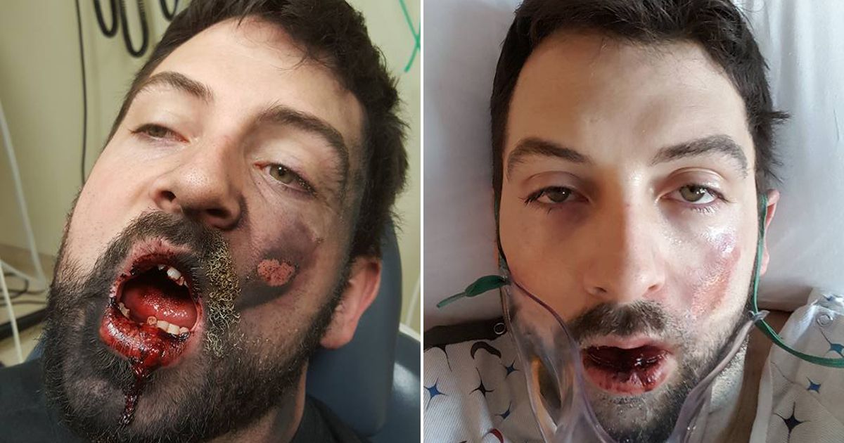 Brûlé par l'explosion de sa cigarette électronique, il perd 7 dents