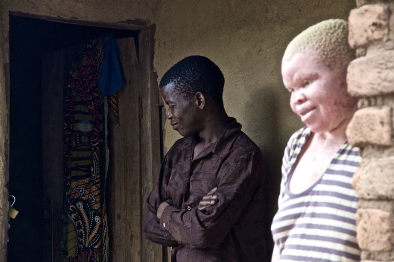 Témoignages- Martha, albinos au Malawi: « J’ai dû me cacher durant neuf jours à cause des tueurs »