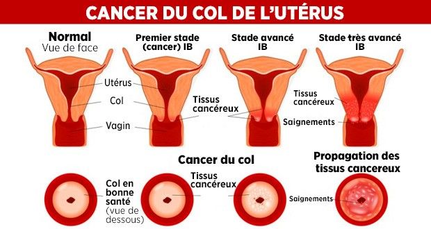 Cancer du col de l’utérus : « Chaque année, le Sénégal enregistre 875 cas », selon la Lisca