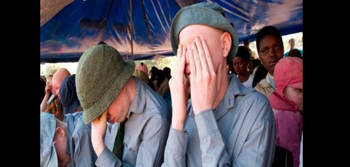 Tanzanie : 34 personnes condamnées à mort pour avoir tué des albinos