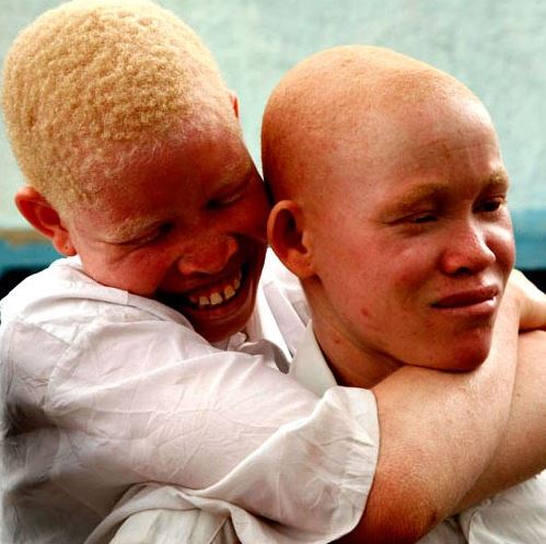 Journée mondiale de sensibilisation à l'albinisme: "Stop aux stigmatisations et aux agressions"