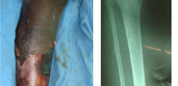 Touba: Mariama Thiongane fracture la jambe de sa voisine