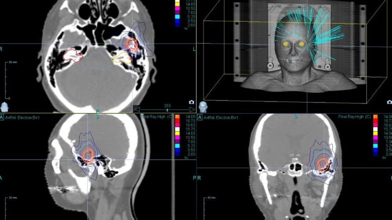 VIDEO - CHU de Bordeaux: un robot révolutionnaire pour soigner le cancer