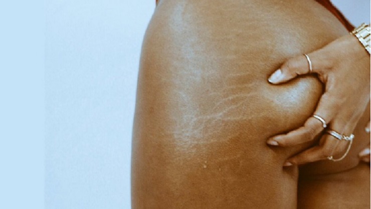 Quelques soins simples et naturels pour se débarrasser des vergetures