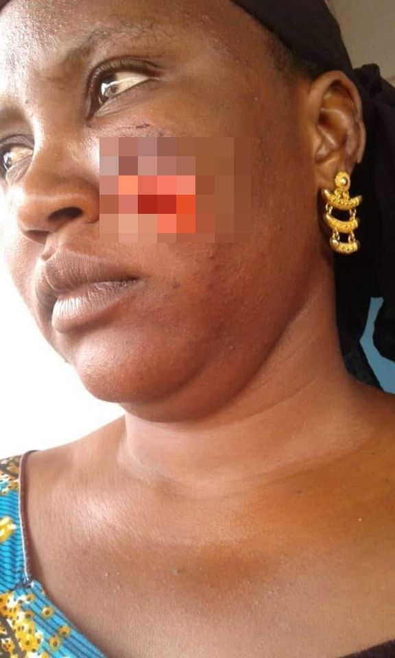 Photo:Sa coépouse lui arrache une partie de la joue avec ses dents