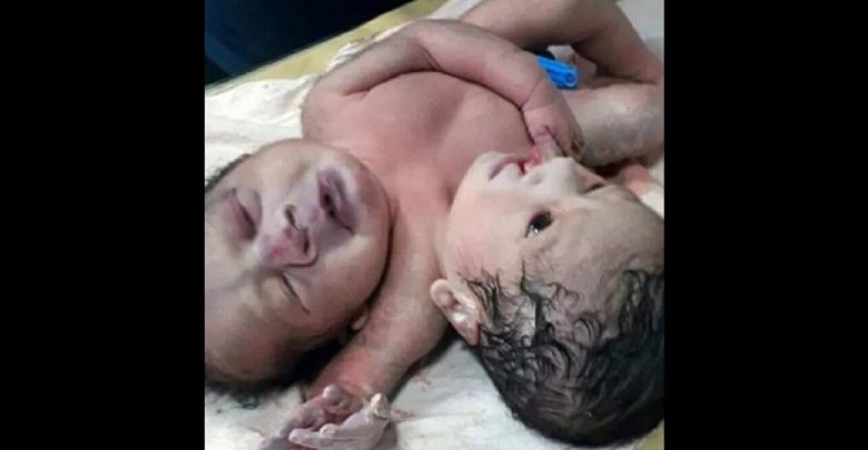 Inde: Une femme donne naissance à des «jumeaux siamois rares»