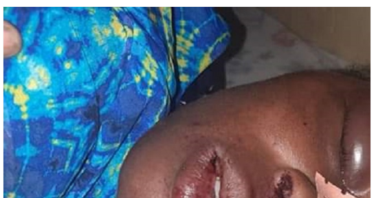 Guédiawaye: Ivre mort, un homme défigure le visage de sa femme (photo)