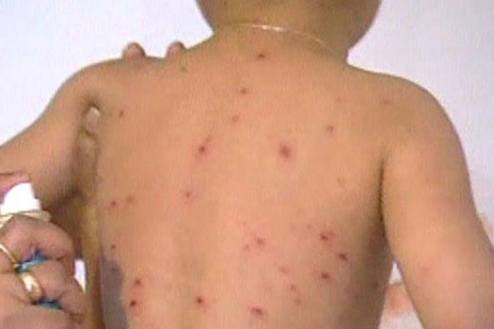 Épidémie de rougeole à Vélingara : 26 cas déjà détectés