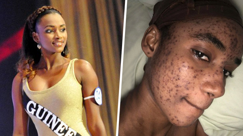 Victime d’une réaction allergique causée par des produits de beauté, la Miss Cedeao 2012 méconnaissable (Photos)