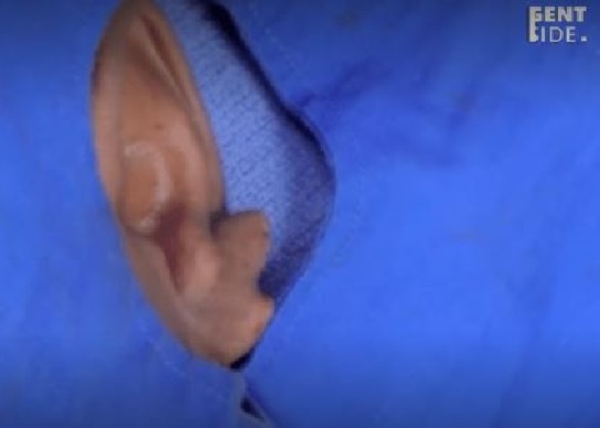 Histoire invraisemblable : un afro-américain se fait retirer un "testicule" de son oreille