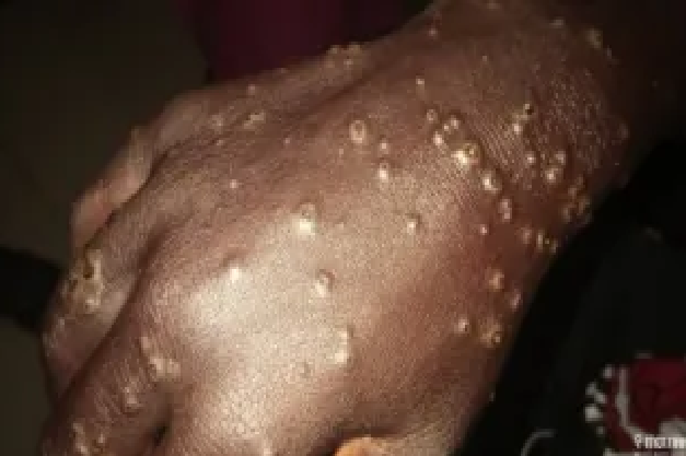 Maladie de la peau, un nouveau cas détecté à Thiaroye-sur-mer: Vers une deuxième vague ?