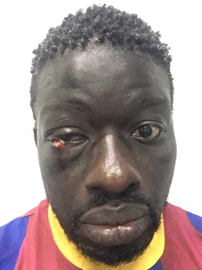 PHOTOS / Lutte: Zoss, blessé à l’oeil face à Alioune Seye 2