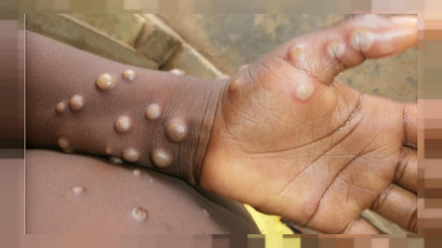 Ce qu’il faut savoir sur l’épidémie de variole du singe et ses différents modes de propagation