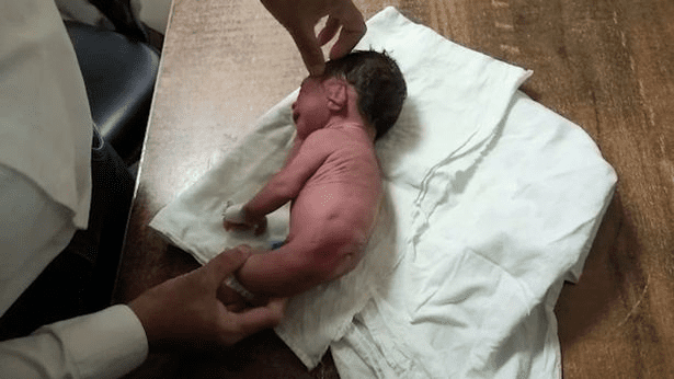 Un bébé né avec une corne étrange au lieu de jambes, laisse les médecins perplexes