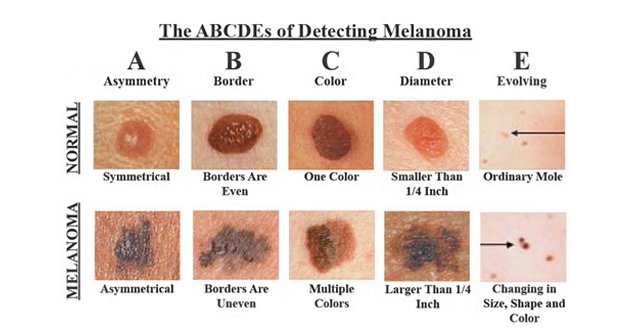 Comment reconnaître le cancer de la peau