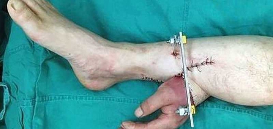Ils lui ont implanté une main dans le pied pour la maintenir en vie… Cette histoire va vous donner des cauchemars