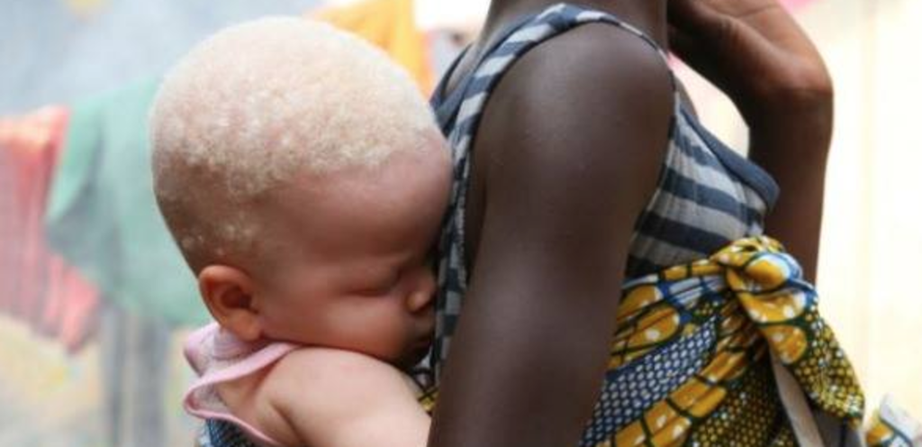 Au Malawi : un instituteur arrêté pour avoir tenté de vendre sa petite amie albinos