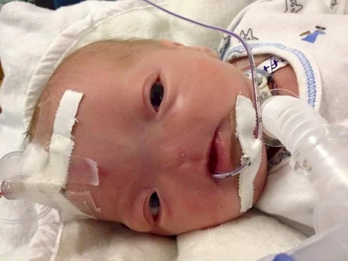Eli, le bébé qui est né sans nez, il continue de se battre pour vivre (photos)