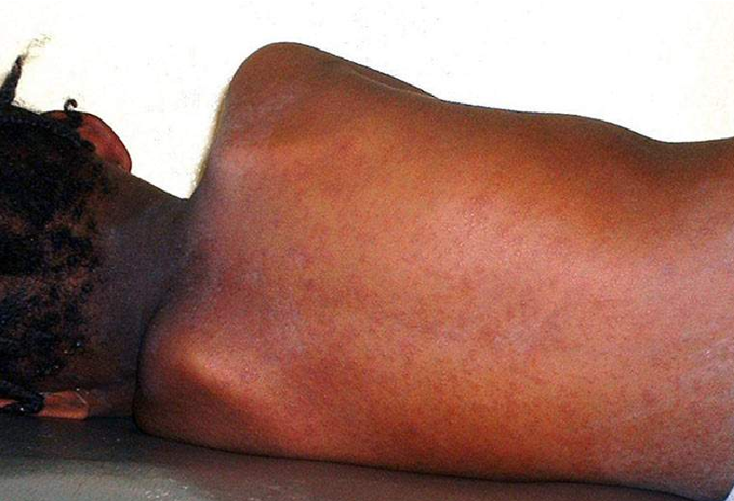 Santé - Epidémie : Le Sénégal a pour le moment enregistré 449 cas de rougeole en 2024