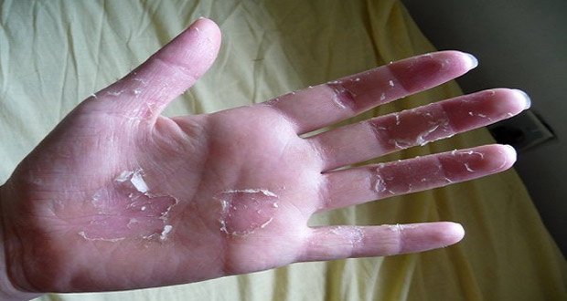 Vos Mains Pelent Voici Des Remedes Efficaces Pour Retrouver Une Peau De Bebe Vos Mains Pelent Voici Des Remedes Efficaces Pour Retrouver Une Peau De Bebe