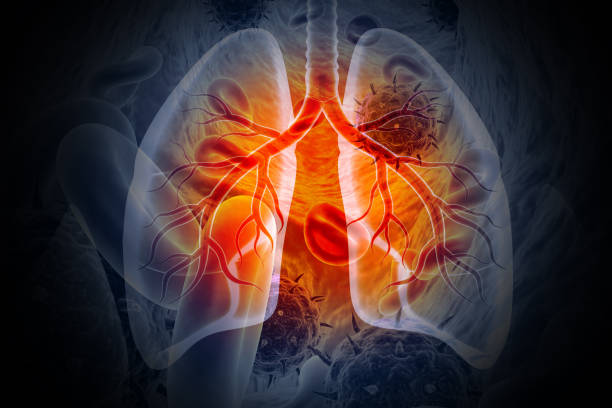 Ziguinchor : 420 cas de tuberculose en six mois, l’alerte est donnée