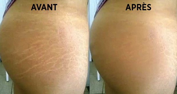 Voici comment se débarrasser naturellement des vergetures en 6 semaines !