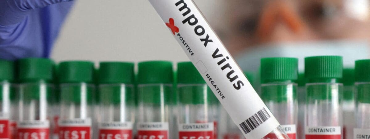 Mpox au Sénégal : Le seul patient recensé est totalement guéri, plus de cas actif de Mpox, vigilance maintenue par le ministère
