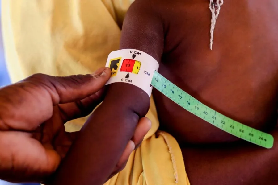 La malnutrition provoque une forme distincte de diabète, concluent des experts mondiaux