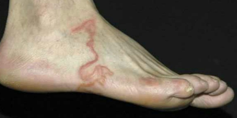 Il pense que c’est juste une varice. Mais lorsque le docteur voit son pied? Horrible!