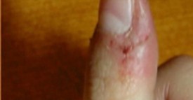 Si vous rongez la peau autour de vos ongles, il faut arrêter. Voici pourquoi.