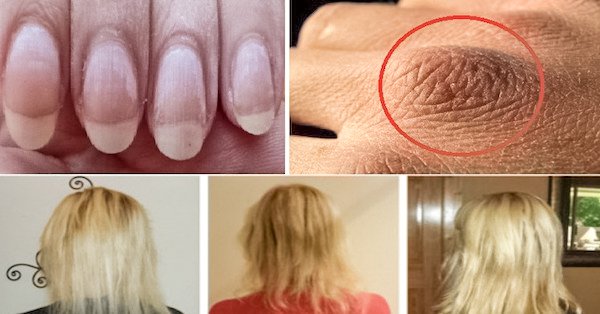 Si vous avez la peau sèche, les ongles cassants ou une chute de cheveux, vous devez d’urgence acheter ces ingrédients !