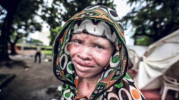 Guinée : le Président Alpha Condé préoccupé par la vulnérabilité des albinos