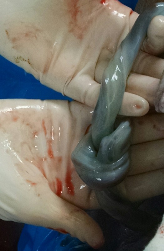 Un papa poste cette photo choc du cordon ombilical de son bébé
