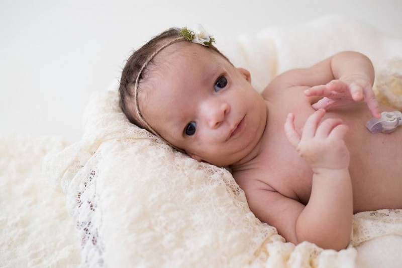 Elle refuse d'adopter un bébé atteint du syndrome de Treacher Collins
