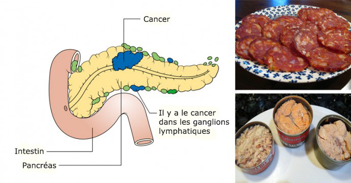 14 aliments cancérigènes que vous ne devriez plus jamais mettre dans votre bouche