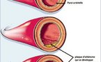MALADIES DU MAL DEVELOPPEMENT, DE L’IGNORANCE... Les affections cardio-vasculaires : ces tueurs en série source de handicaps