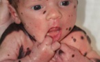 Un bébé avec une maladie de peau se fait poser des implants
