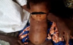 Au Togo, une fillette naît sans bras