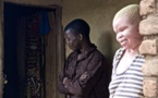 Témoignages- Martha, albinos au Malawi: « J’ai dû me cacher durant neuf jours à cause des tueurs »