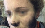 Ses écouteurs explosent à son visage en plein vol alors qu'elle écoute de la musique: elle a des brûlures un peu partout sur le corps (photos)