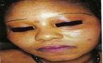 QUE CACHE LA DEPIGMENTATION CHIMIQUE (OU ‘’KHESSAL’’) ? … LE MAL EST CERTAINEMENT AILLEURS !!!