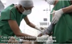 Brésil: De la peau de poisson pour soulager les grands brûlés