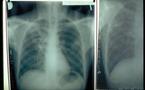 PROPAGATION DE LA TUBERCULOSE  L’ampleur devient inquiétante dans les banlieues