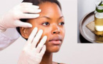 3 astuces naturelles pour combattre teigne et dartre