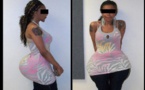 Des injections de silicone dans les fesses paralysent un mannequin