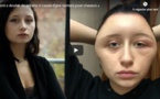 Défigurée après une coloration pour cheveux, Estelle, 19 ans, a frôlé la mort