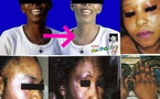 La dépigmentation a la peau dure