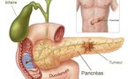 Cancer du pancréas : quels sont les facteurs de risque ?